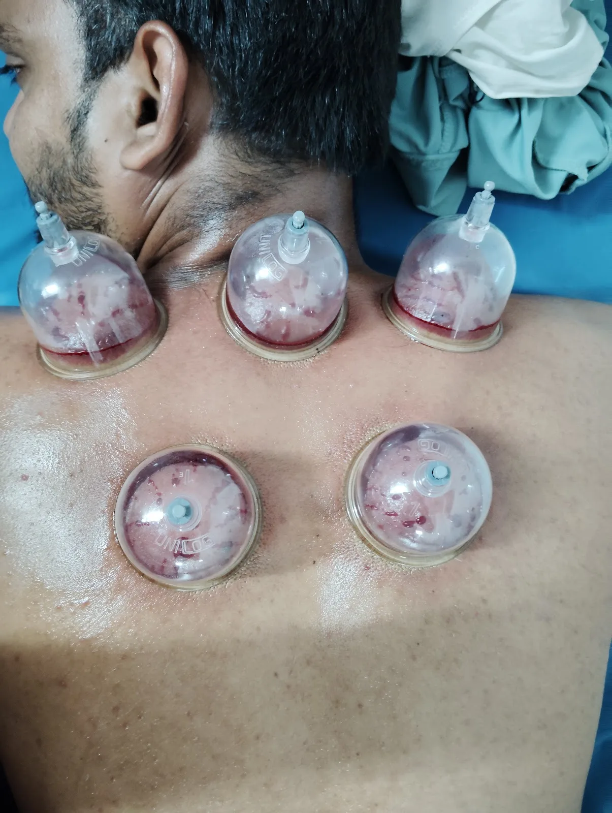 India Physiotherapy & Anaya HIjama Centre