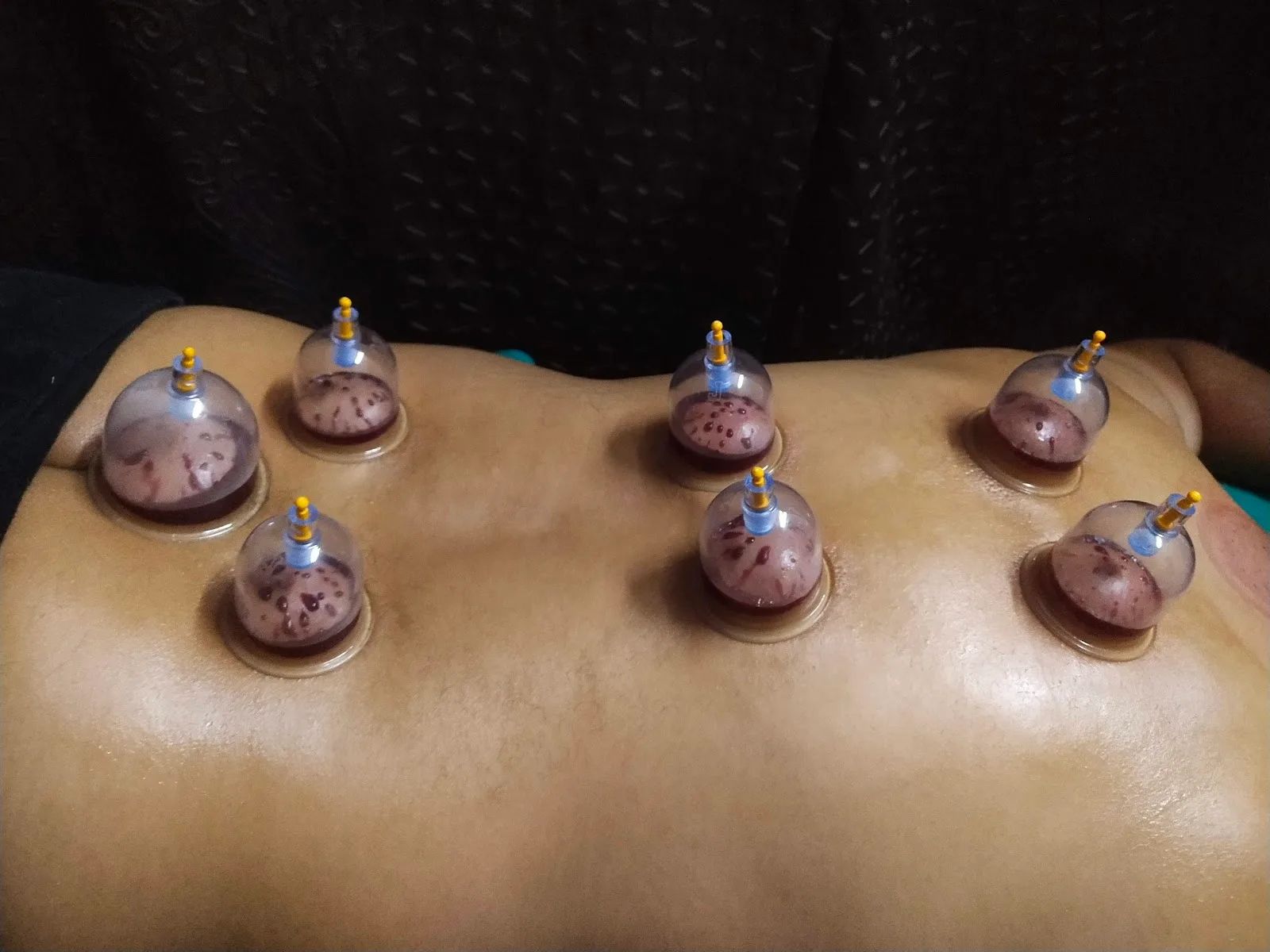 India Physiotherapy & Anaya HIjama Centre