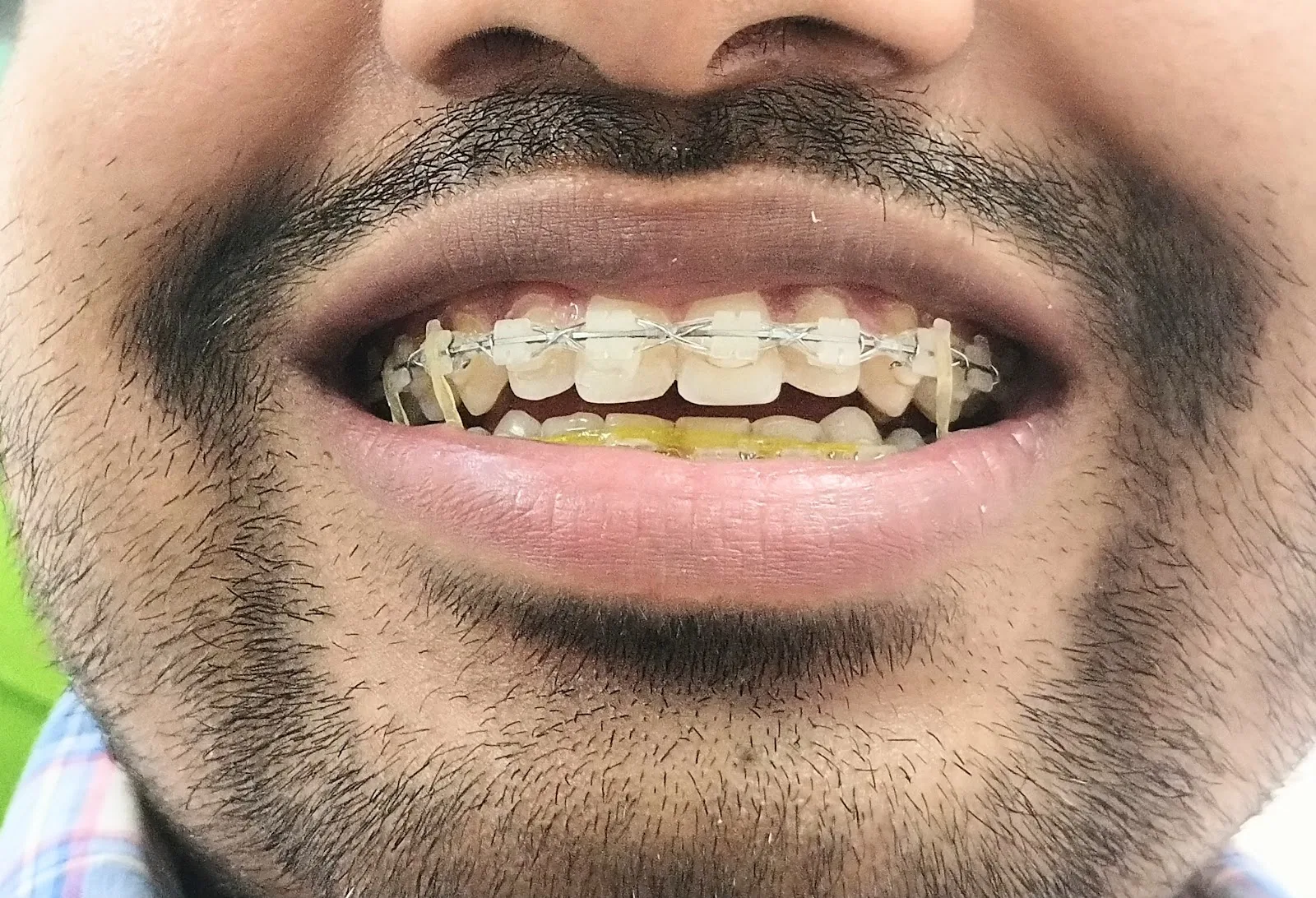 Karol bagh charitable dental Clinic